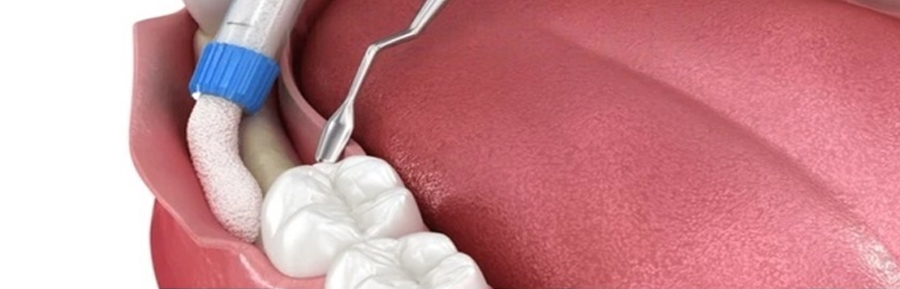 When Bone Grafts Go Wrong: 5 Terrifying Outcomes You Can Avoid